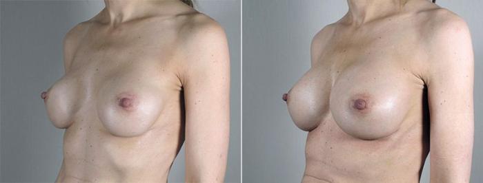 Breast Implant Revision Case 599 Before & After View #2 | Paramus, New Jersey | Parker Center for Plastic Surgery
