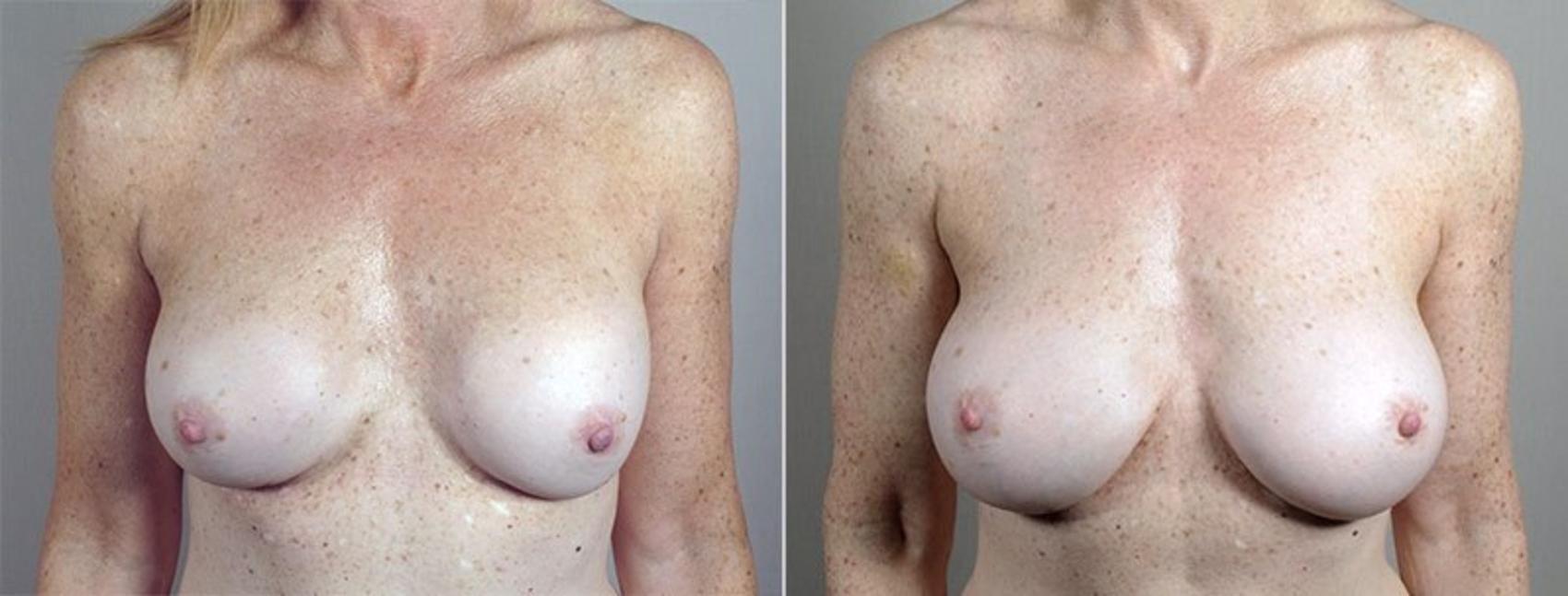 Breast Implant Revision Case 600 Before & After View #1 | Paramus, New Jersey | Parker Center for Plastic Surgery