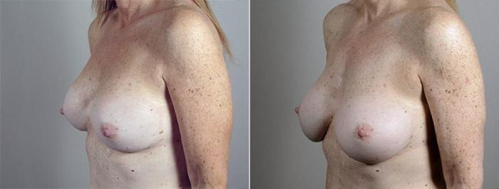 Breast Implant Revision Case 600 Before & After View #2 | Paramus, New Jersey | Parker Center for Plastic Surgery