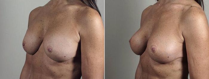 Breast Implant Revision Case 601 Before & After View #2 | Paramus, New Jersey | Parker Center for Plastic Surgery