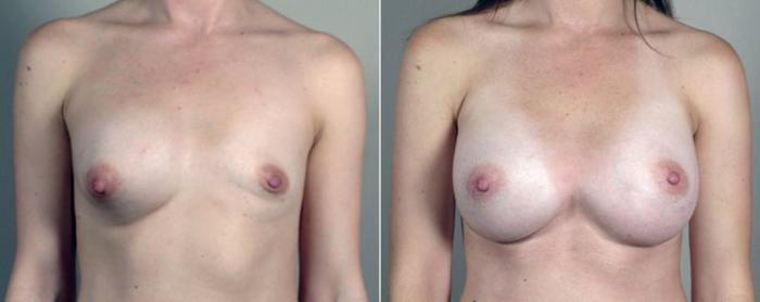 Breast Implant Revision Case 602 Before & After View #1 | Paramus, New Jersey | Parker Center for Plastic Surgery