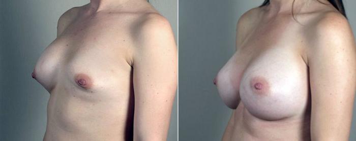 Breast Implant Revision Case 602 Before & After View #2 | Paramus, New Jersey | Parker Center for Plastic Surgery