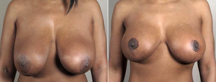 Breast Implant Revision Case 603 Before & After View #1 | Paramus, New Jersey | Parker Center for Plastic Surgery