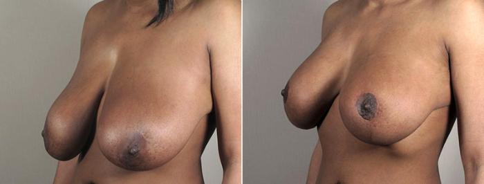 Breast Implant Revision Case 603 Before & After View #2 | Paramus, New Jersey | Parker Center for Plastic Surgery