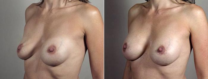 Breast Implant Revision Case 604 Before & After View #2 | Paramus, New Jersey | Parker Center for Plastic Surgery
