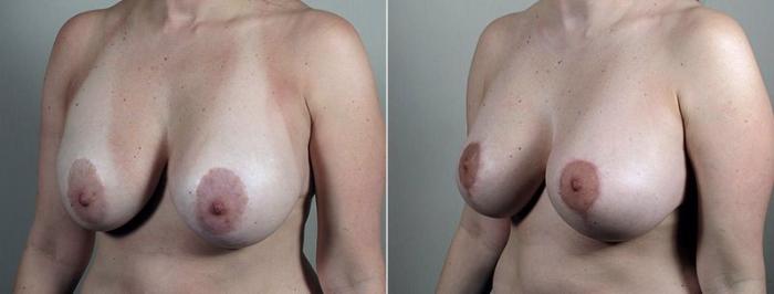 Breast Implant Revision Case 605 Before & After View #2 | Paramus, New Jersey | Parker Center for Plastic Surgery