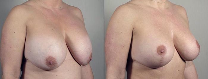 Breast Implant Revision Case 606 Before & After View #2 | Paramus, New Jersey | Parker Center for Plastic Surgery