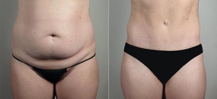 Breast Implant Revision Case 606 Before & After View #3 | Paramus, New Jersey | Parker Center for Plastic Surgery