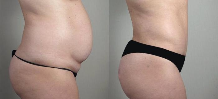 Breast Implant Revision Case 606 Before & After View #4 | Paramus, New Jersey | Parker Center for Plastic Surgery