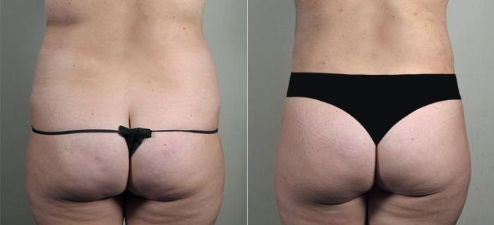 Breast Implant Revision Case 606 Before & After View #5 | Paramus, New Jersey | Parker Center for Plastic Surgery