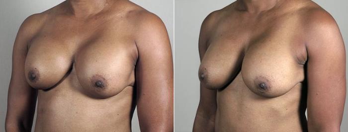 Breast Implant Revision Case 607 Before & After View #2 | Paramus, New Jersey | Parker Center for Plastic Surgery