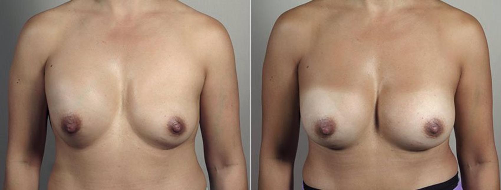 Breast Implant Revision Case 608 Before & After View #1 | Paramus, New Jersey | Parker Center for Plastic Surgery