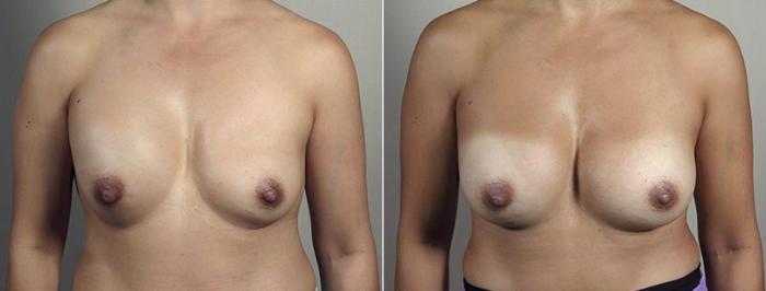 Breast Implant Revision Case 608 Before & After View #1 | Paramus, New Jersey | Parker Center for Plastic Surgery