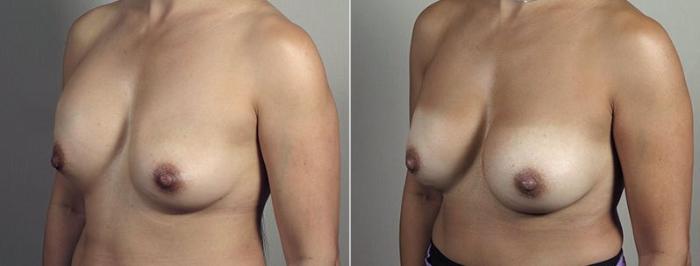 Breast Implant Revision Case 608 Before & After View #2 | Paramus, New Jersey | Parker Center for Plastic Surgery