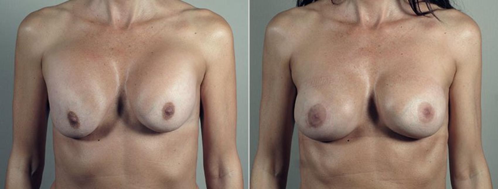 Breast Implant Revision Case 609 Before & After View #1 | Paramus, New Jersey | Parker Center for Plastic Surgery