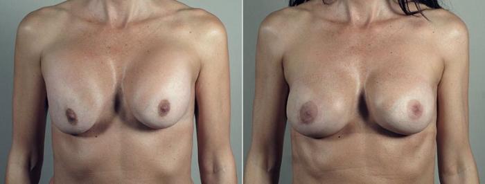 Breast Implant Revision Case 609 Before & After View #1 | Paramus, New Jersey | Parker Center for Plastic Surgery