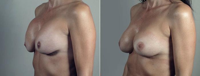 Breast Implant Revision Case 609 Before & After View #2 | Paramus, New Jersey | Parker Center for Plastic Surgery
