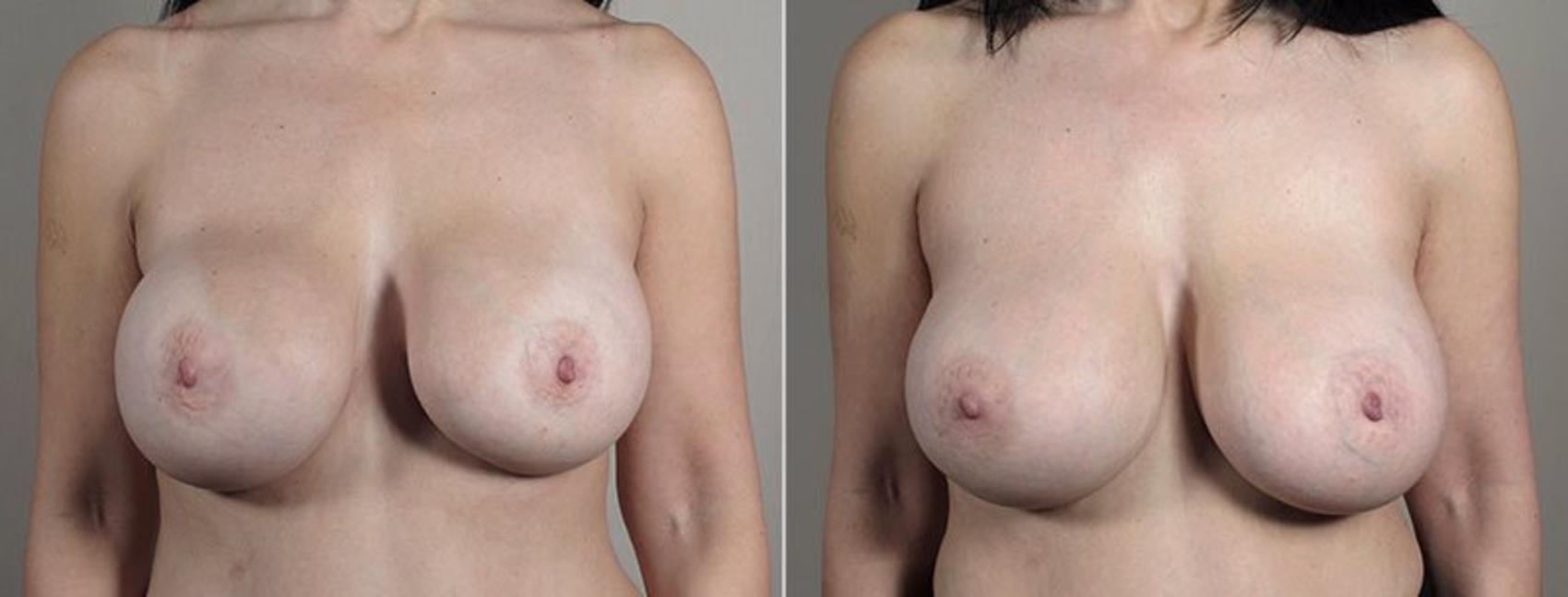 Breast Implant Revision Case 610 Before & After View #1 | Paramus, New Jersey | Parker Center for Plastic Surgery