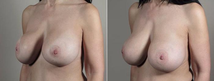 Breast Implant Revision Case 610 Before & After View #2 | Paramus, New Jersey | Parker Center for Plastic Surgery
