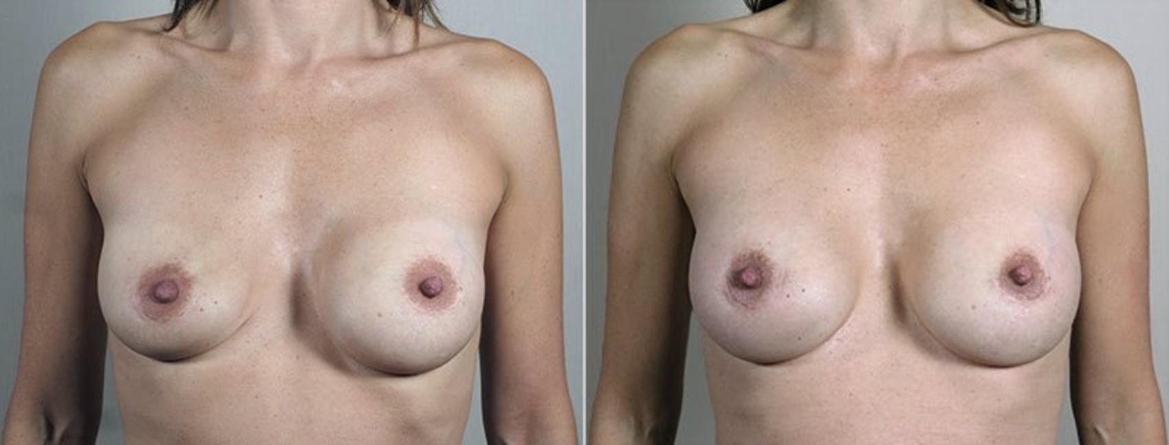 Breast Implant Revision Case 611 Before & After View #1 | Paramus, New Jersey | Parker Center for Plastic Surgery