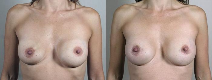 Breast Implant Revision Case 611 Before & After View #1 | Paramus, New Jersey | Parker Center for Plastic Surgery
