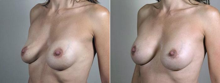 Breast Implant Revision Case 611 Before & After View #2 | Paramus, New Jersey | Parker Center for Plastic Surgery