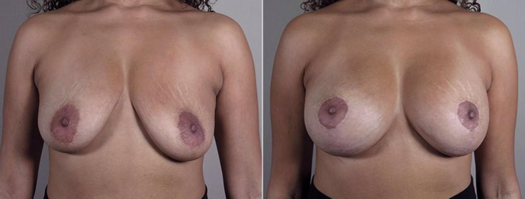 Breast Implant Revision Case 612 Before & After View #1 | Paramus, New Jersey | Parker Center for Plastic Surgery