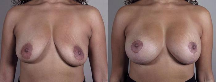 Breast Implant Revision Case 612 Before & After View #1 | Paramus, New Jersey | Parker Center for Plastic Surgery