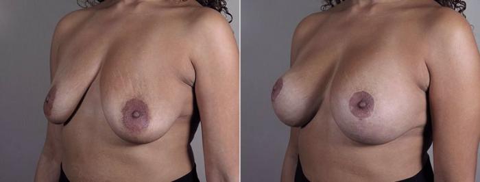 Breast Implant Revision Case 612 Before & After View #2 | Paramus, New Jersey | Parker Center for Plastic Surgery