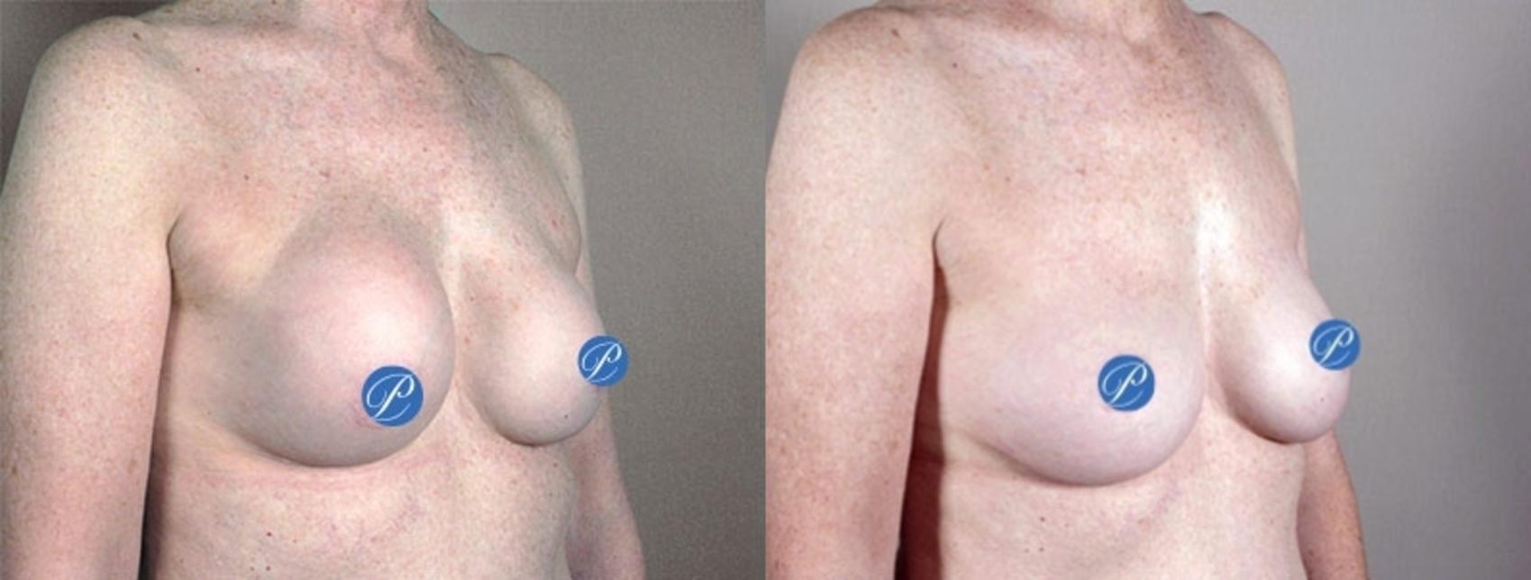 Breast Implant Revision Case 905 Before & After View #5 | Paramus, New Jersey | Parker Center for Plastic Surgery