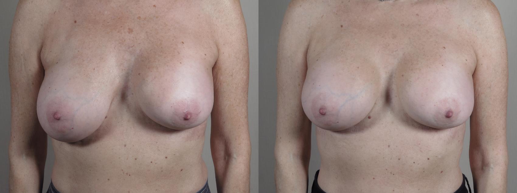 Breast Implant Revision Case 966 Before & After Front | Paramus, New Jersey | Parker Center for Plastic Surgery