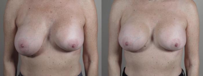Breast Implant Revision Case 966 Before & After Front | Paramus, New Jersey | Parker Center for Plastic Surgery