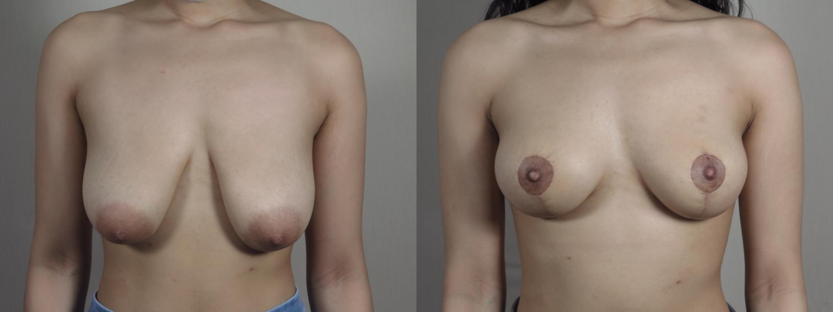 Breast Lift Case 1028 Before & After Front | Paramus, New Jersey | Parker Center for Plastic Surgery