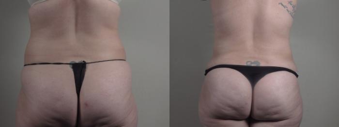Breast Lift Case 1298 Before & After Back | Paramus, New Jersey | Parker Center for Plastic Surgery