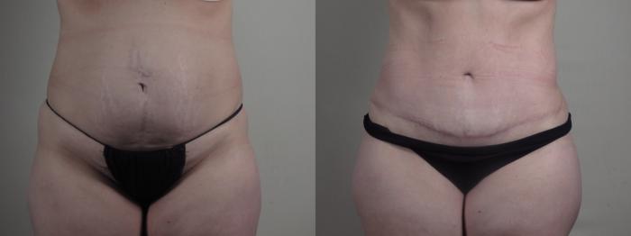 Breast Lift Case 1298 Before & After front  | Paramus, New Jersey | Parker Center for Plastic Surgery