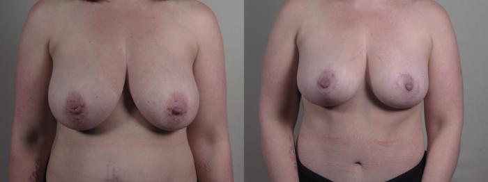 Breast Lift Case 1298 Before & After Front | Paramus, New Jersey | Parker Center for Plastic Surgery