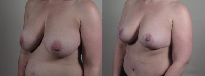 Breast Lift Case 1298 Before & After Left Oblique | Paramus, New Jersey | Parker Center for Plastic Surgery