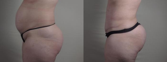 Breast Lift Case 1298 Before & After Left Side | Paramus, New Jersey | Parker Center for Plastic Surgery