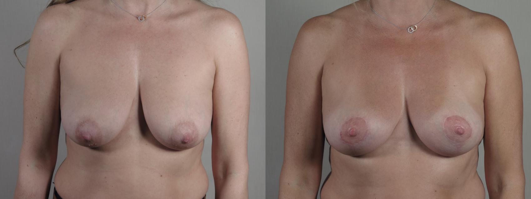 Breast Lift Case 1309 Before & After Front | Paramus, New Jersey | Parker Center for Plastic Surgery