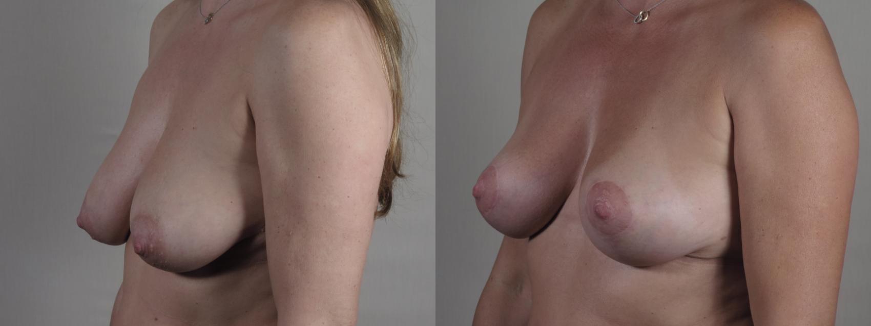 Breast Lift Case 1309 Before & After Left Oblique | Paramus, New Jersey | Parker Center for Plastic Surgery