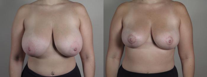 Breast Lift Case 1330 Before & After Front | Paramus, New Jersey | Parker Center for Plastic Surgery