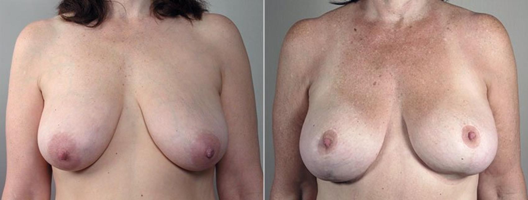 Breast Lift Case 501 Before & After View #1 | Paramus, New Jersey | Parker Center for Plastic Surgery