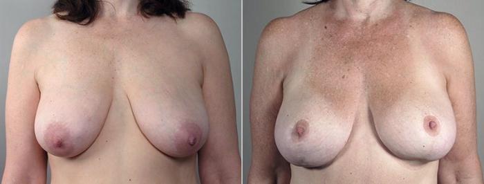 Breast Lift Case 501 Before & After View #1 | Paramus, New Jersey | Parker Center for Plastic Surgery