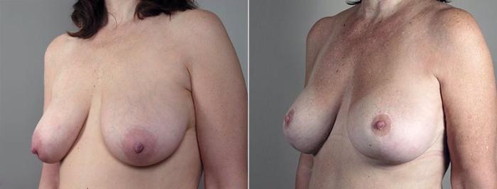 Breast Lift Case 501 Before & After View #2 | Paramus, New Jersey | Parker Center for Plastic Surgery