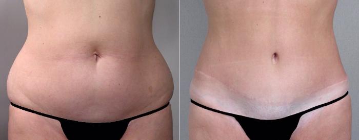 Breast Lift Case 501 Before & After View #3 | Paramus, New Jersey | Parker Center for Plastic Surgery