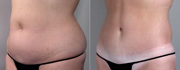 Breast Lift Case 501 Before & After View #4 | Paramus, New Jersey | Parker Center for Plastic Surgery
