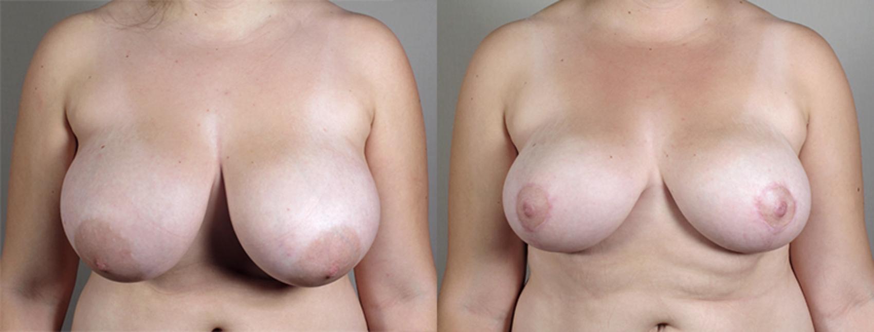 Breast Lift Case 514 Before & After View #1 | Paramus, New Jersey | Parker Center for Plastic Surgery