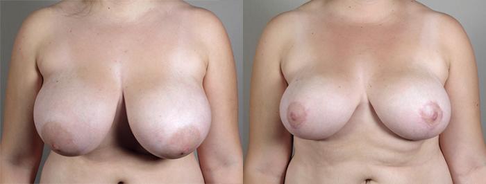 Breast Lift Case 514 Before & After View #1 | Paramus, New Jersey | Parker Center for Plastic Surgery