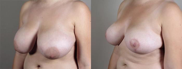 Breast Lift Case 514 Before & After View #2 | Paramus, New Jersey | Parker Center for Plastic Surgery