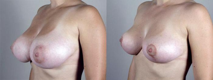 Breast Lift Case 529 Before & After View #2 | Paramus, New Jersey | Parker Center for Plastic Surgery